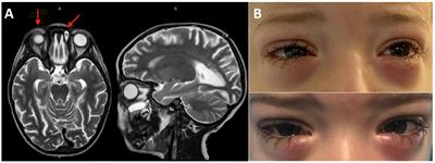 Case report: EBV-related eye orbits and sinuses lymphohistiocytic infiltration responsive to rituximab in a patient with X lymphoproliferative syndrome type 1